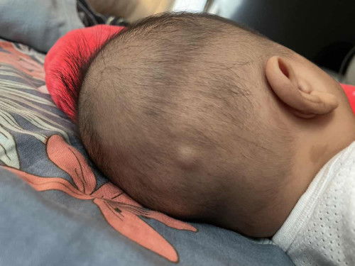 Bump/Knot on baby’s head