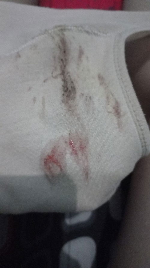 Kalau ngeflek kaya gini gimana ya, ngeflek udah 4 harian ngfleknya saya takut kalau terjadi  sesuatu