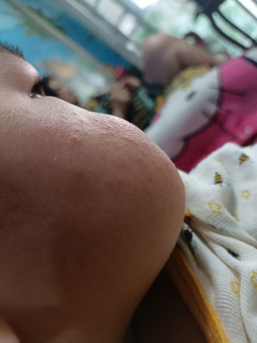 ผดผื่นเป็นเม็ดๆที่แก้ม