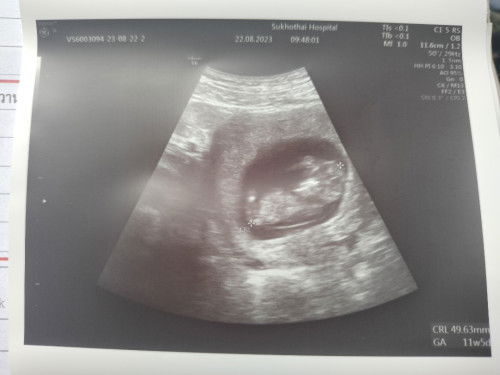 11วีค+4 น้องเป็นทารกเเล้วใช่ไหม