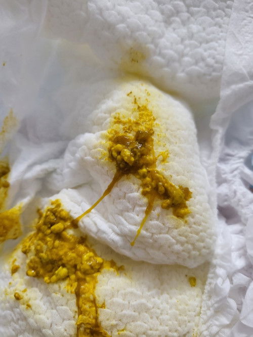 Con e 1th10 ngay đi phân co dịch nhầy màu nâu v có s k các mom ơi