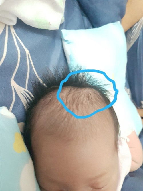 #ลูกหัวปูดบวมค่ะ