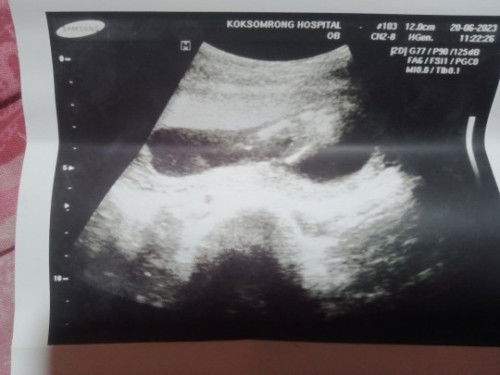อยากทราบว่าน้องเป็นผญหรือชายคะ
พอดีดูม่ออกคะ ตอนที่ไปซาวน์พึ่งได้15สัปดาห์คะ 
 ##ขอบคุณล่วงหน้านะคะ