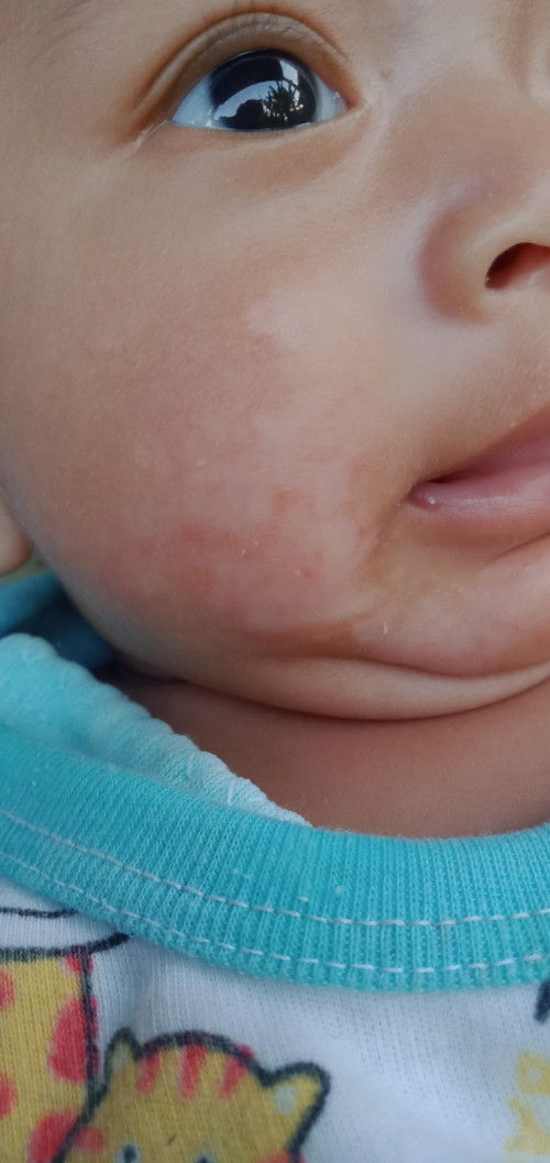 Kulit bayi muncul bercak