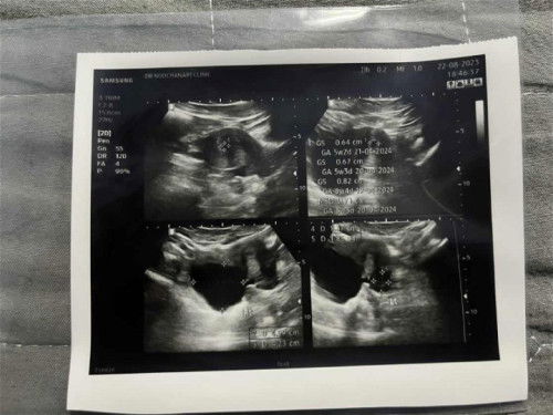 เจอซีส เจอถุงการตั้งครรภ์แต่ยังไม่เจอน้อง