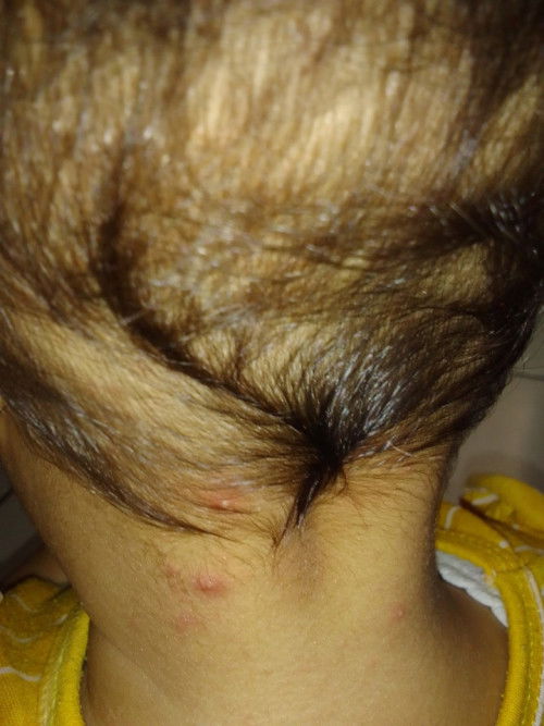 Bun mao tanya anak aku akhir akhir ini suka keluar bintik bintik kaya ada nanahnya apa itu cacar