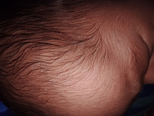 Bintik di kepala bayi