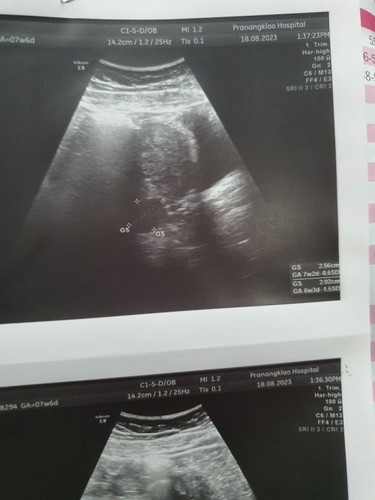 อัลตร้าซาวด์ไม่เจอตัวอ่อน