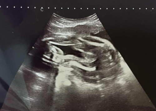 Gender Reveal