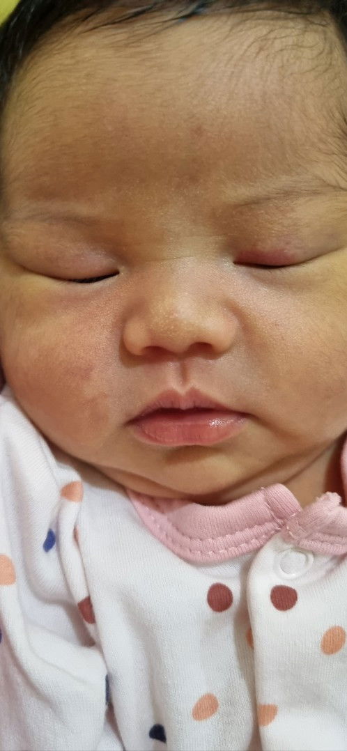 Bintik kuning di hidung