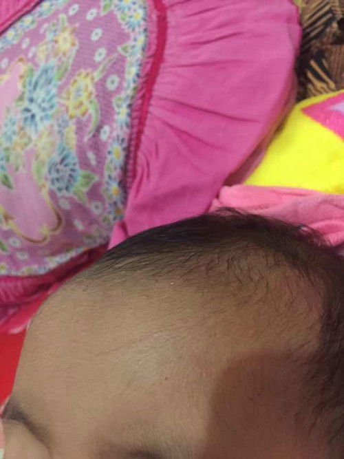 Bruntusan hanya di jidat