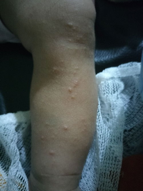 Untuk menghilangkan bentol bekas gigitan nyamuk pake apa ya moms?