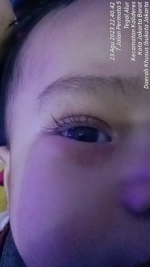 Hello bunda bunda cara nyembuhin bintik bintik merah di deket pinggiran bola mata boat nya apa yah