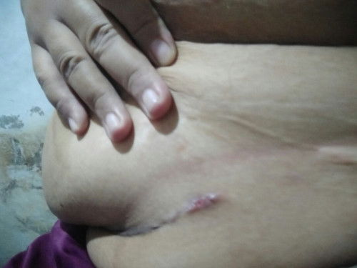 bekas jahitan sc terbuka setelah 2 bulan