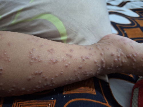 Gatal gatal pada anak usia 2 tahun