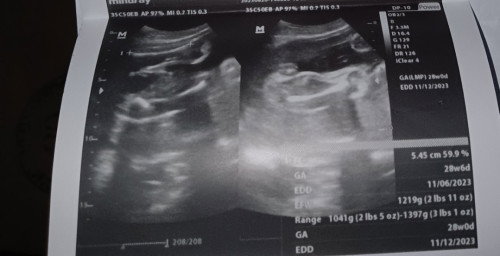 Gender ultrasound 🥰female🥰