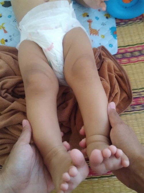สวัสดีค่ะ สอบถามหน่อยค่ะ ขาโก่ง
แบบนี้ขาน้องโก่งปาติไหมค่ะแม่ค่ะ