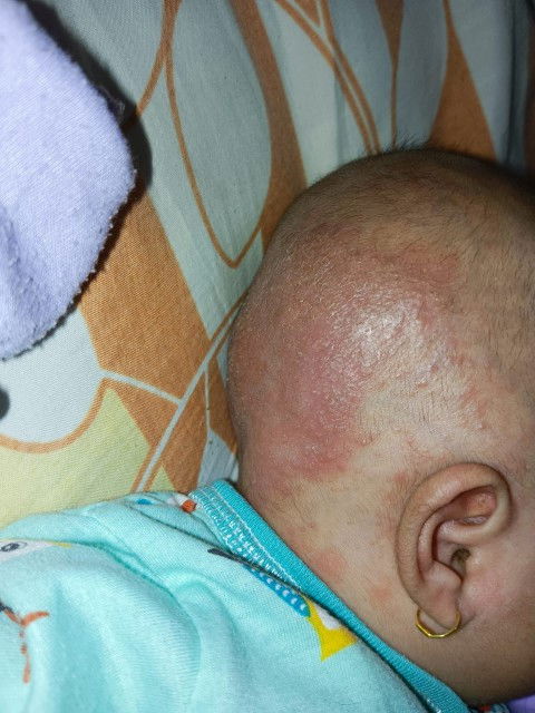 Ruam / merah2 dikulit kepala anak