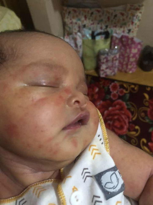 Bintik merah di muka bayi