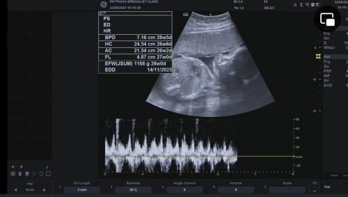 น้ำหนักน้องในครรภ์เกินเกณฑ์