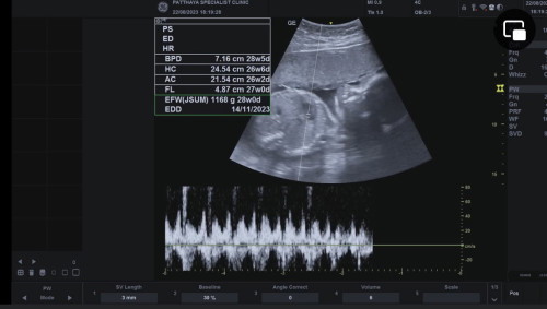 น้ำหนักน้องในครรภ์เกินเกณฑ์