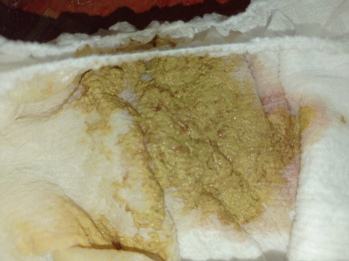 Poops ng 1yr old teething baby