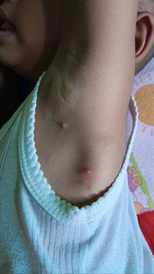 Gatal anak usia 18bln