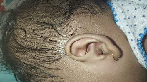 Benjolan di lubang telinga (bayi 1 tahun)