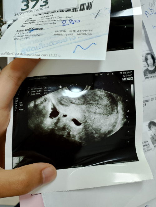 แท้งจริงหรอคะ