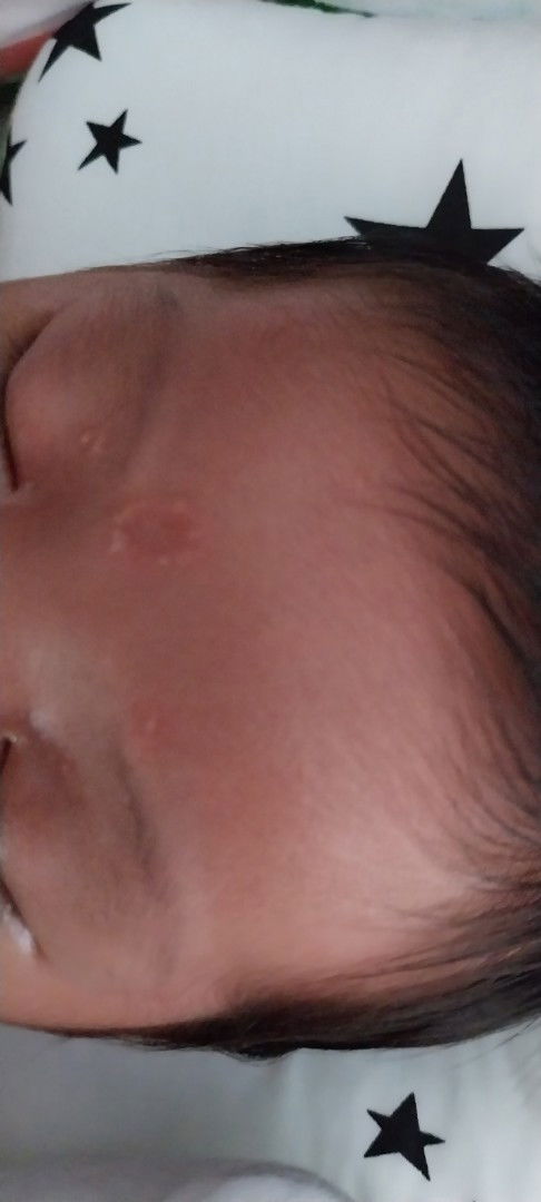 Mga mie ano po kaya ito nasa mukha ni LO.ano po kaya gamot na pwede?dumadami po kase.salamat mga mie