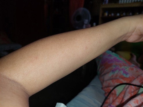 May parang rashes si mommy