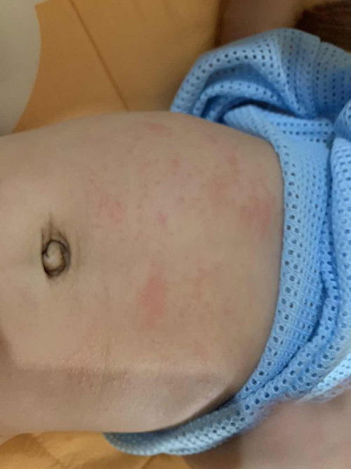 ตุ่มแดงๆเรียกว่าอะไรคะแบบนี้แพ้หรือว่าอะไรคะ