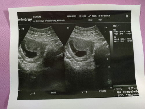 Hasil usg 8w janin berkembang tdk sesuai usia.