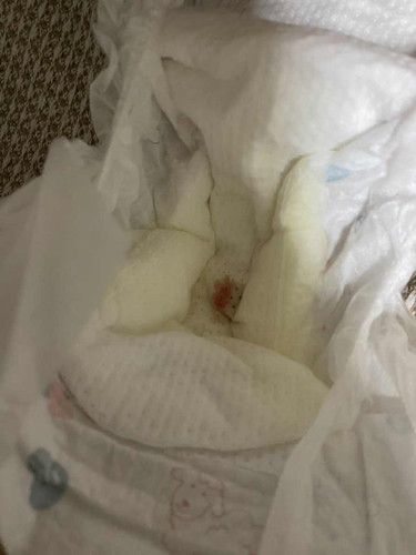 Baby kencing berdarah