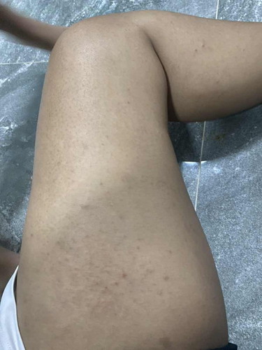 ผื่นคันขึ้นเต็มขาเลยค่ะ