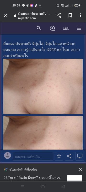 เป็นผื่น จั้มๆ มีต่ำใสเม็ดนึง ที่เหลือเหมือนตุ่มยุงกัดอันตรายไหม 25+5