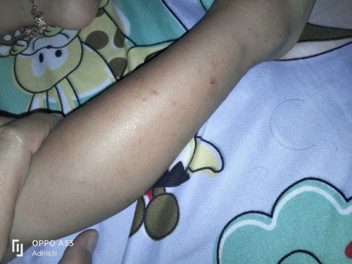 Bekas luka gigitan nyamuk