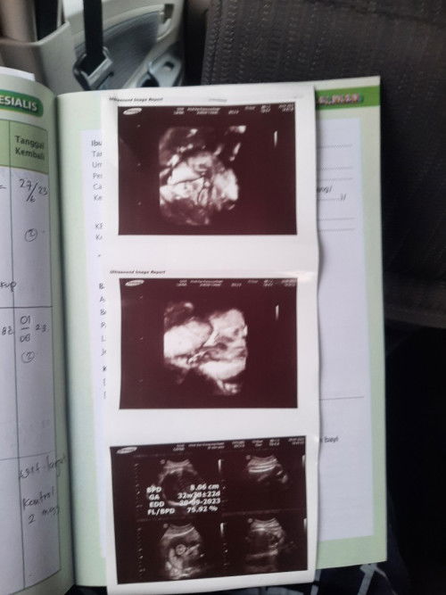 Ciri² kepala bayi sudah masuk panggul kaya gimana ya?