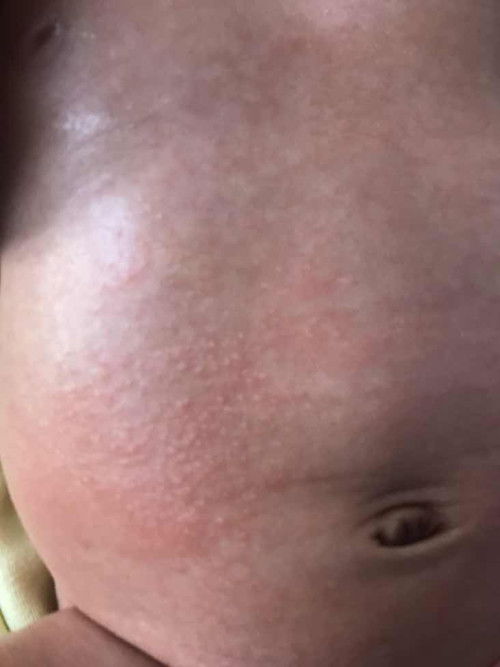 Merah merah di badan (bayi 1 bulan 21 hari)