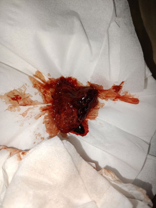 Gumpalan darah nifas