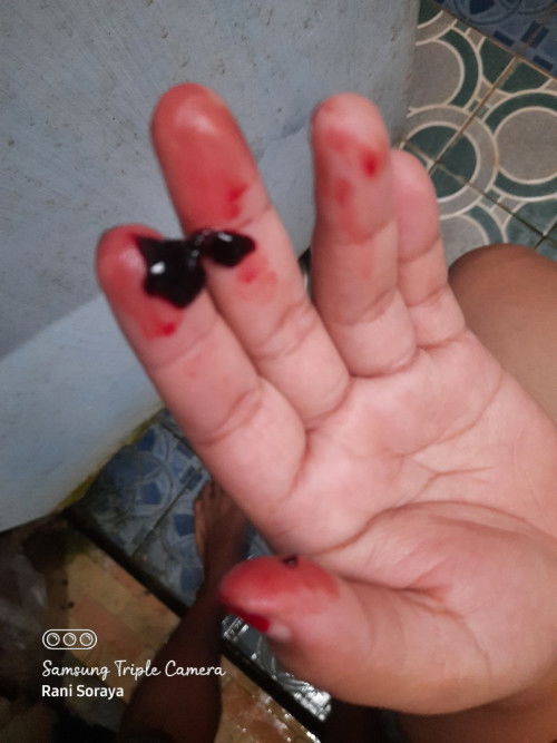 Hamil 9 week tiba2 keluar gumpalan darah seperti di foto badan langsung lemes mau periksa belum buka