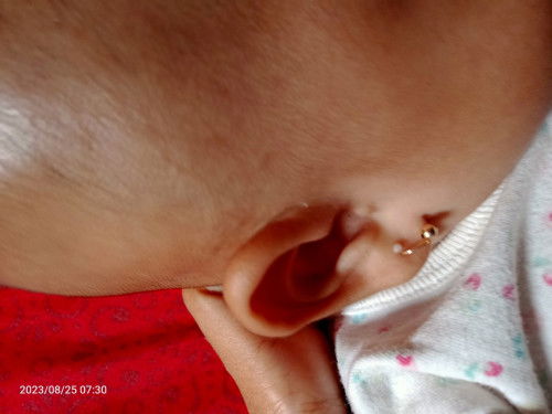 Ada semacam jerawat di telinga