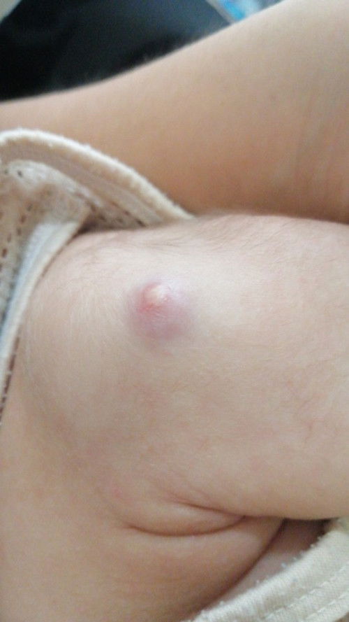 วิธีดูแลฝี