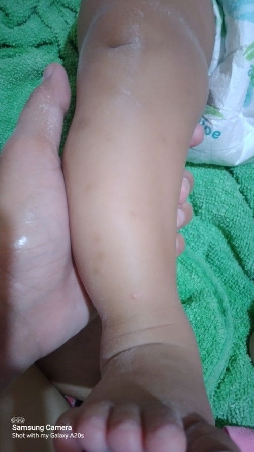 Peklat kagat ng langgam