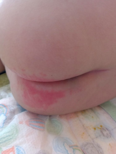 Diaper rash