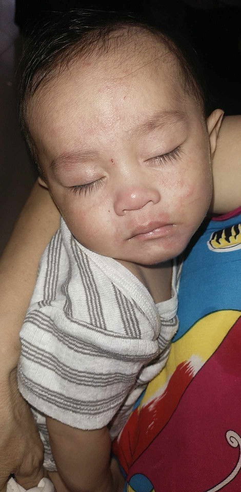 Question po is anyone knows this kind of allergies since baby he is like this.he 7 months old