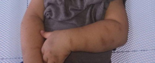 Cara menghilangkan bekas hitam di kulit bayi usia 1 tahun