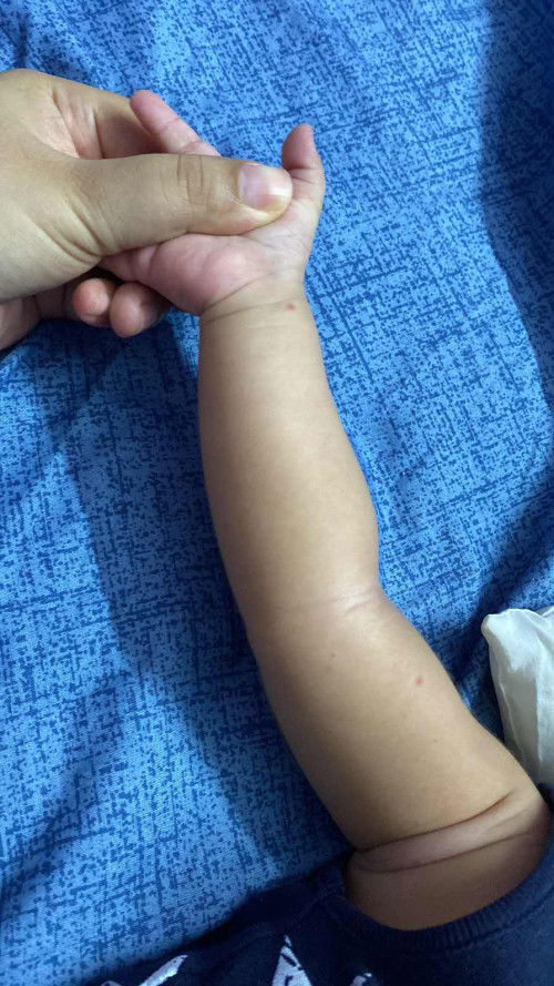 HFMD ATAU BINTIK GATAL?