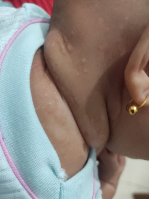 Cara mengatasi ruam pada bagian leher new born