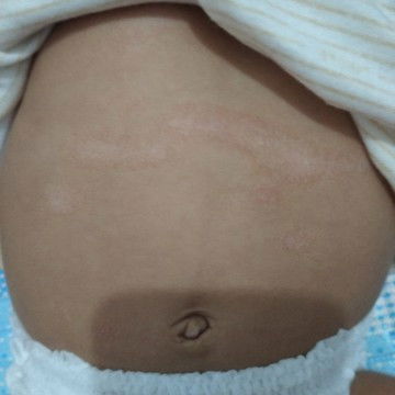 Ruam di perut makin lebar